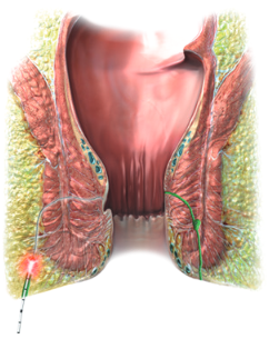 FiLac (Fistula-tract Laser Closure)