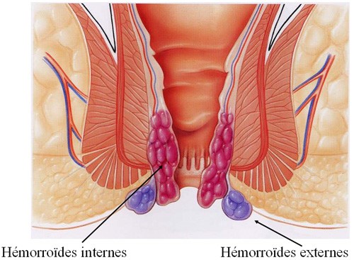 hemorroides - Traitement à la Clinique Mutualiste AÉSIO Santé de Saint-Etienne