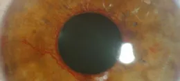 retinopathiediabvisuel