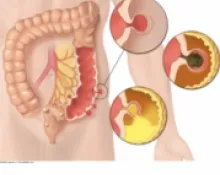 Diverticulose sigmoïdienne