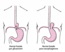 Hernie hiatale et Reflux gastro-oesophagien