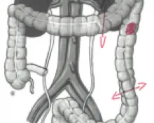 Cancer du colon gauche