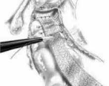Prolapsus rectal