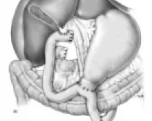 Double dérivation bilio-digestive