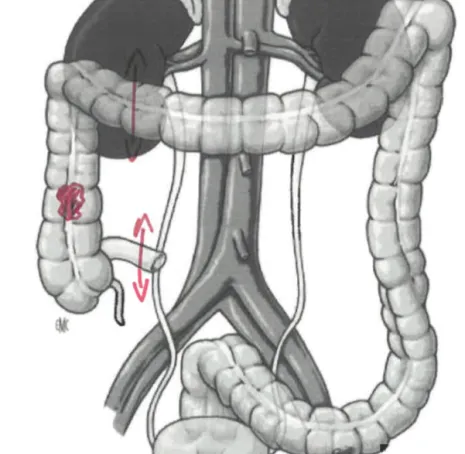 Cancer du colon droit 