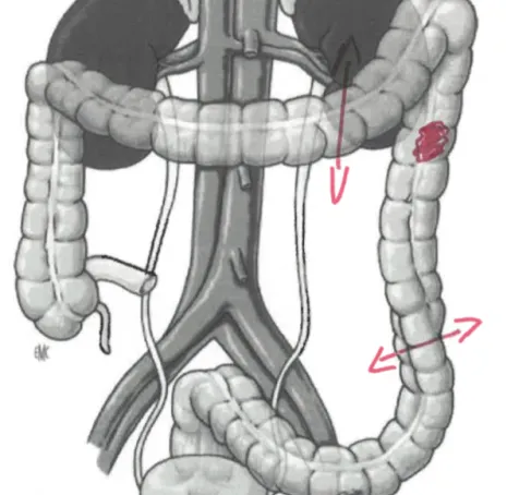 Cancer colon gauche