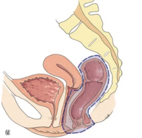 Cancer du rectum