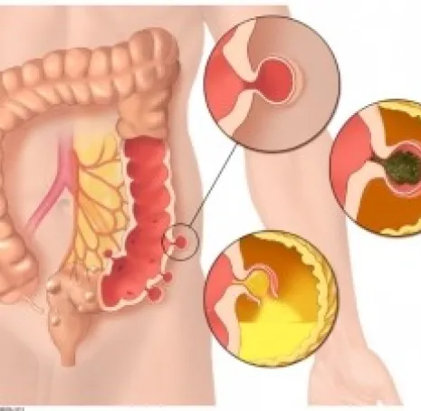 Diverticulose Sigmoïdienne