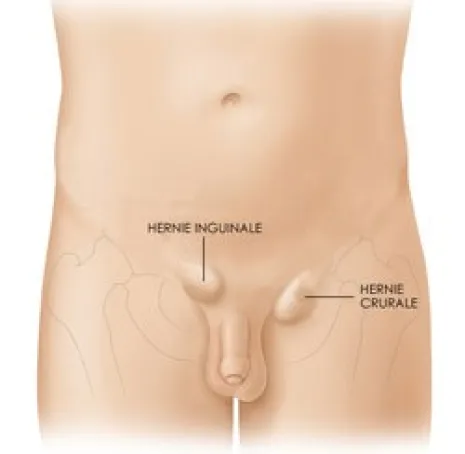 Hernies de l’aine