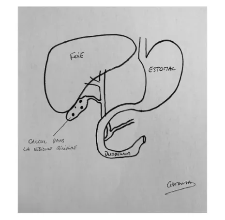 Cholécystectomie