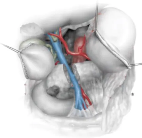 Intervention - Duodéno-pancréatectomie céphalique