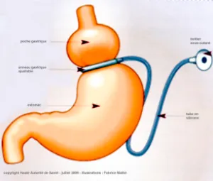 Ablation d’anneau