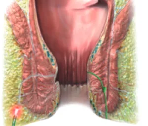 FiLac (Fistula-tract Laser Closure)